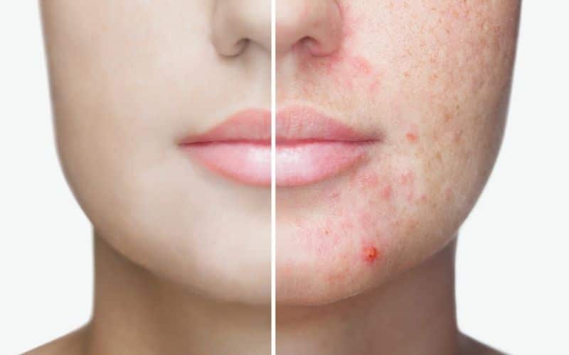 How to care for your skin  if you are prone to acne