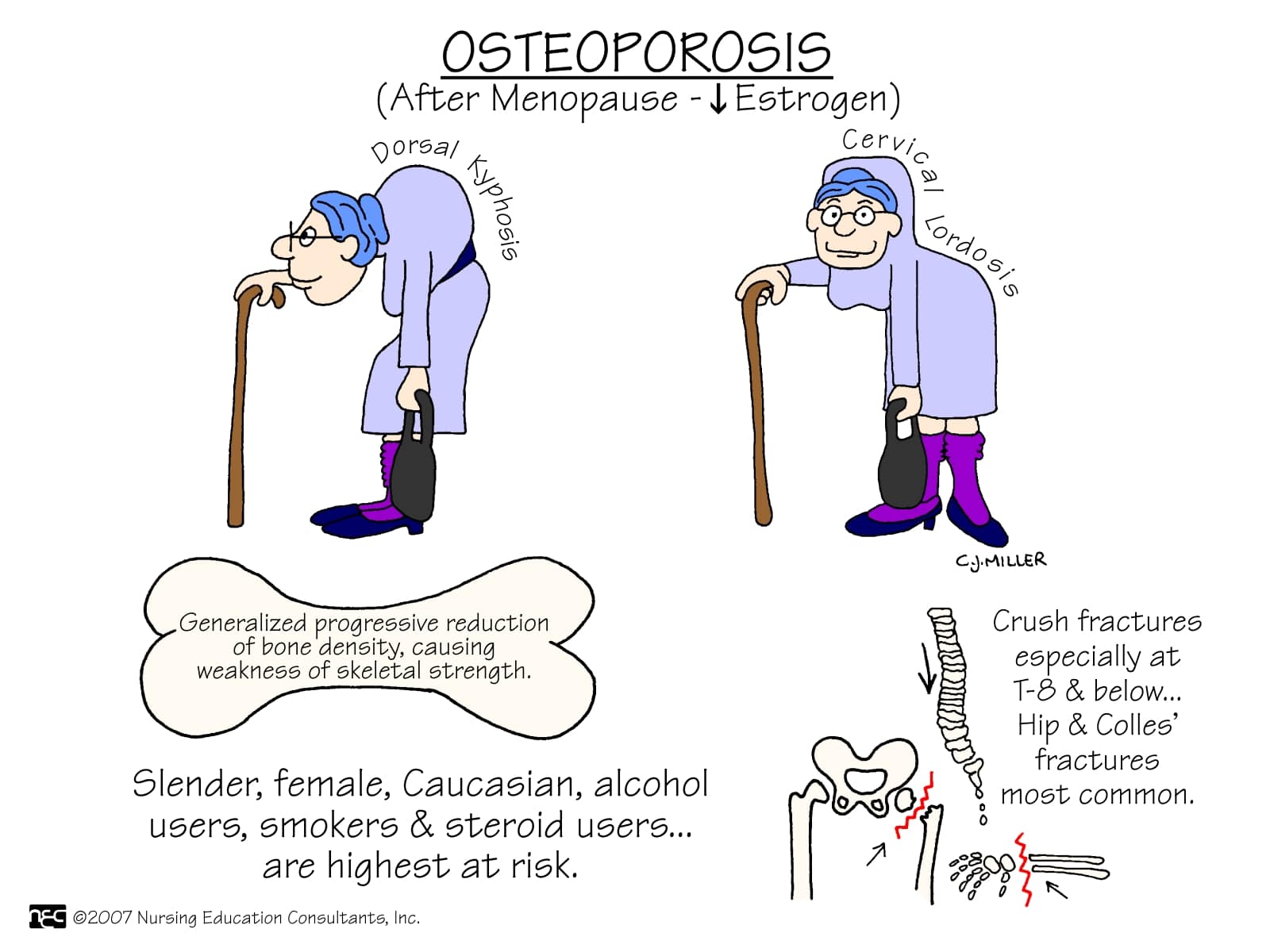 The Natural Treatment For Osteoporosis - My Life With No Drugs