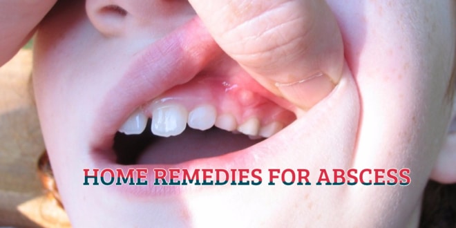 HOME REMEDIES FOR ABSCESS