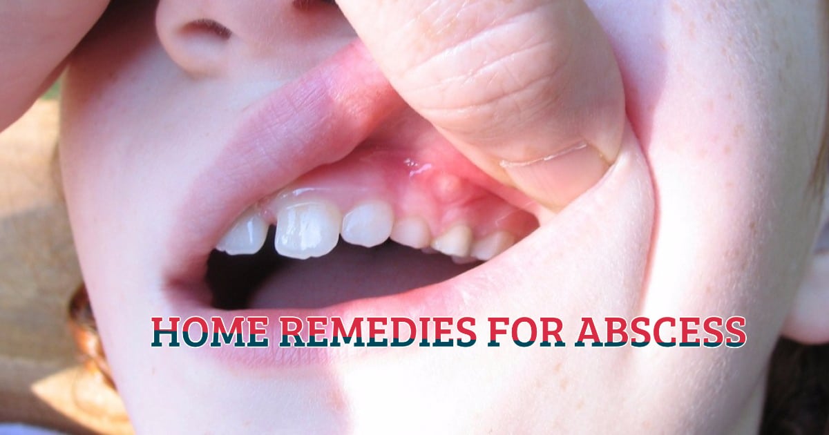 Home Remedies For Abscess - Healthy Lifestyle