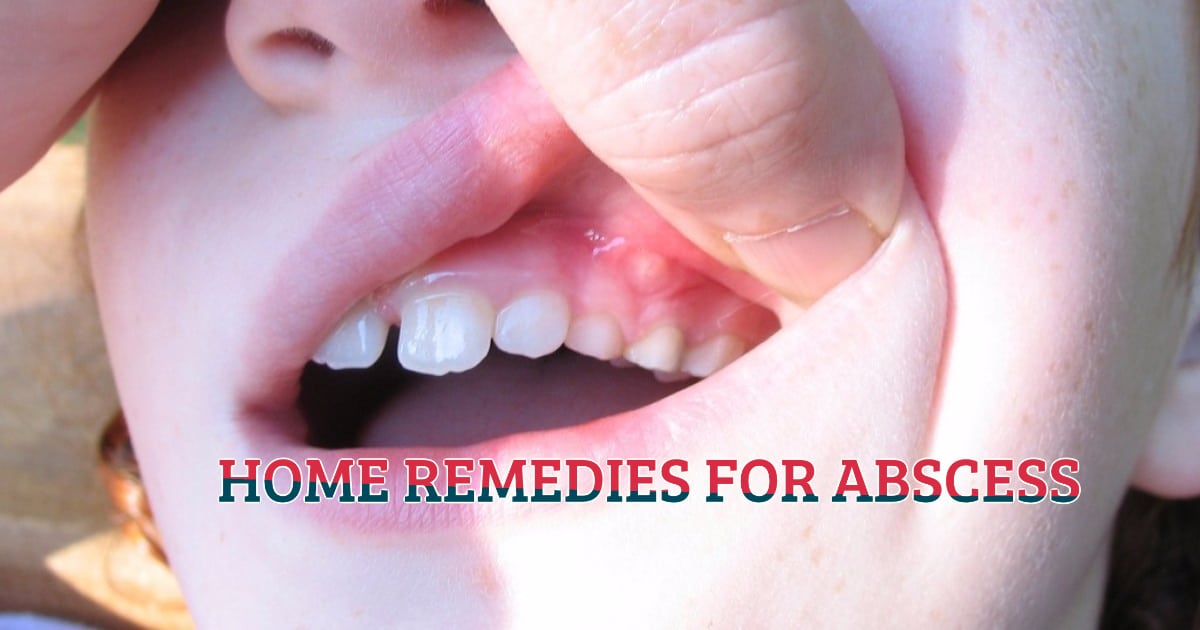 Home Remedies For Abscess My Life With No Drugs