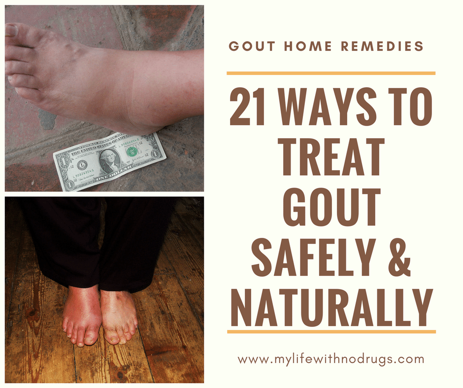 21 Home Remedies For Gout Treat Gout Safely And Naturally My Life With