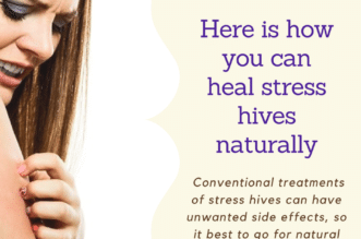 stress hives