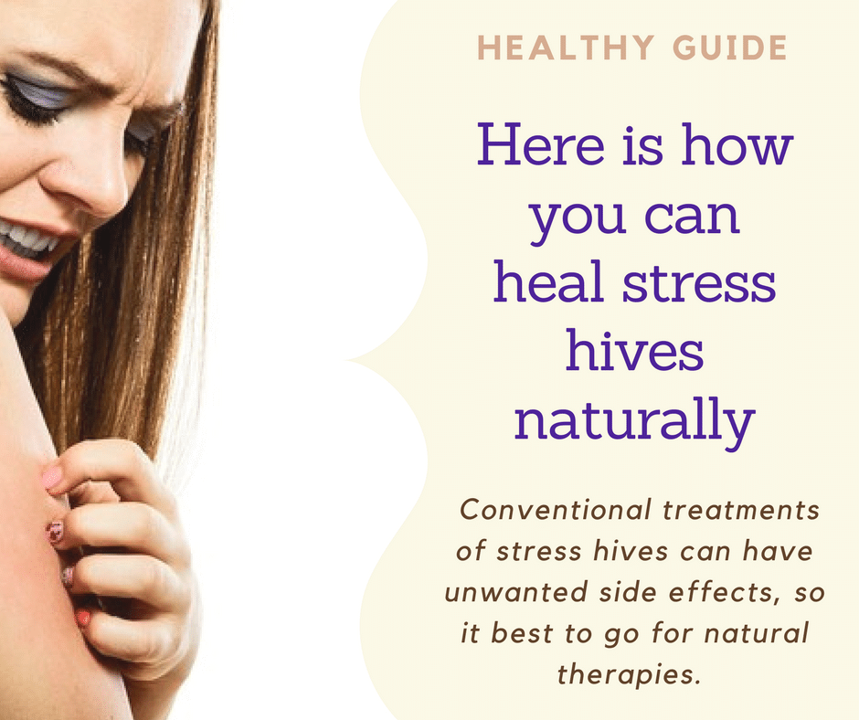 Natural Treatments Of Stress Hives My Life With No Drugs