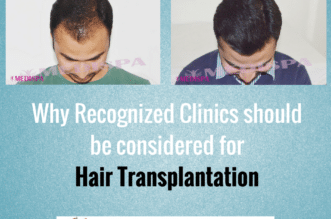 A man before and after hair transplantation with the text Why Recognized Clinics should be considered for Hair Transplantation