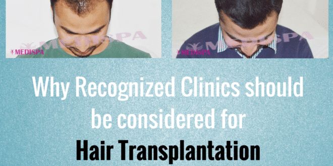 A man before and after hair transplantation with the text Why Recognized Clinics should be considered for Hair Transplantation
