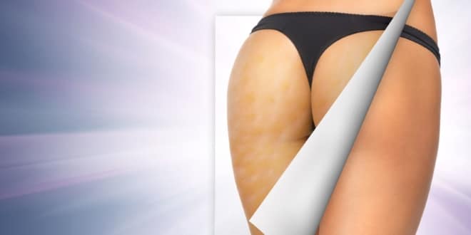 Cellulite Home Remedies that Actually Show Results, How to get rid of Cellulite with Cellulite Home Remedies #HomeRemedies #home #homes #cellulite #remedies #remedy #AntiCellulite