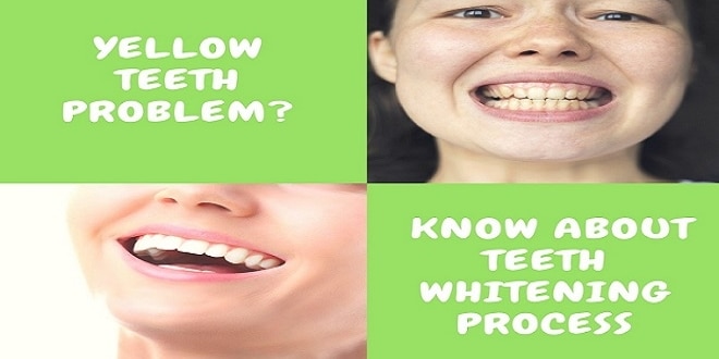 Yellow Teeth? 3 Important Aspects Know About Teeth Whitening | Teeth Whitening process | teeth yellowing #TeethWhitening #Yellow #Aspects #Yellows