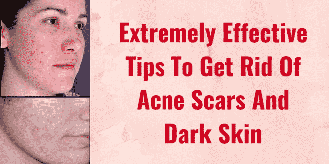 Extremely Effective Tips To Get Rid Of Acne Scars And Dark Skin