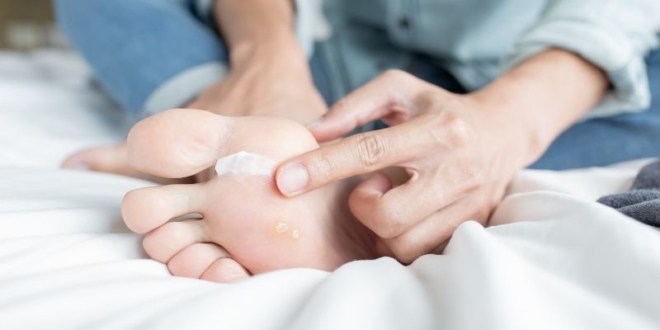 Home Remedies for Athlete's Foot